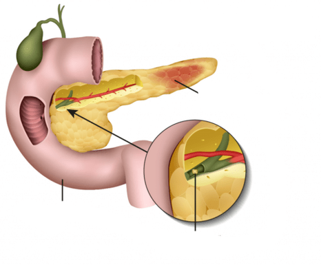 панкреатит - это воспаление поджелудочной железы. 